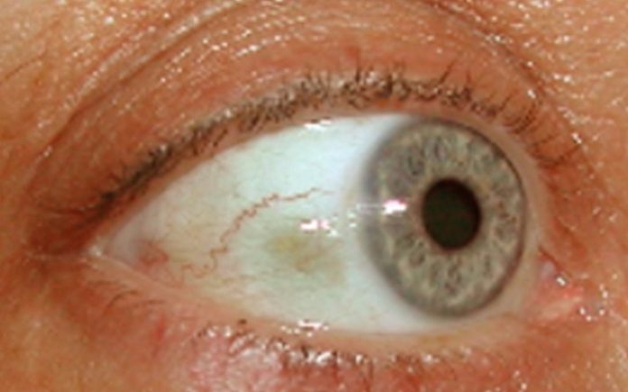 Bubble On Eyeball Causes And Treatment