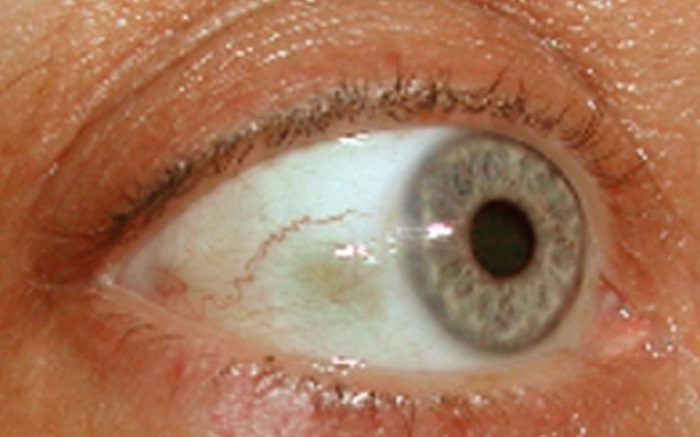 bubble-on-eyeball-causes-and-treatment